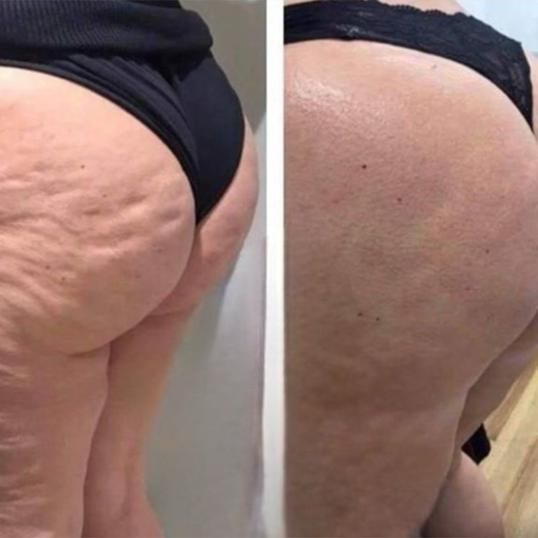 celulitis-y-reafirmación